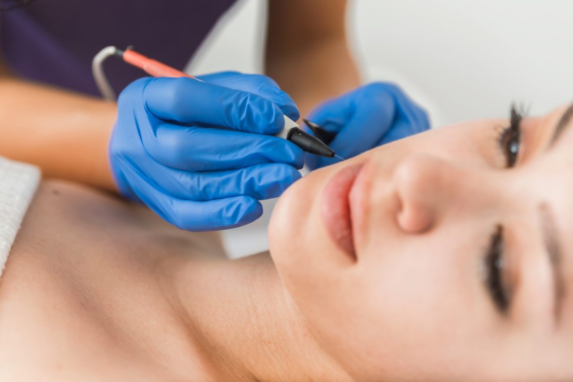 Epilation electrolyse